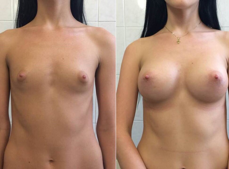 Foto prima e dopo l'utilizzo della crema Wow Bust di Anna da Berlino